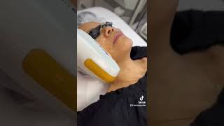 IPL Photofacial treatment for Pigmentation Removal [upl. by Davie]