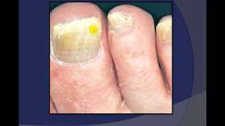 Toenail Debridement by a Podiatrist [upl. by Kimber]