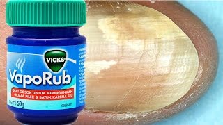 How To Treat Toenail Fungus With VICKS VAPORUB [upl. by Aiuqat121]