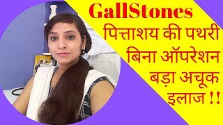 Gallstones symptoms amp homeopathic treatment  gallbladder stones symptoms amp homeopathic medicine [upl. by Francesca]