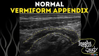 Normal Vermiform Appendix  Ultrasound  Case 50 [upl. by Ciredec958]