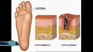 Medicina Facile  Curare il Piede diabetico [upl. by Aerua]