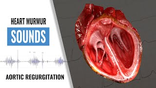 Aortic Regurgitation Heart Sound  Heart Murmur  Christina NP [upl. by Evot]