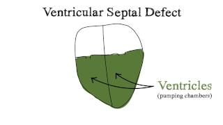 Ventricular Septal Defect VSD [upl. by Norrehc]