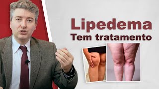 Tratamento de Lipedema Tem tratamento [upl. by Yromem]