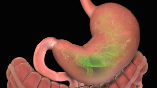 Stomach Ulcer  Nucleus Health [upl. by Ashly]