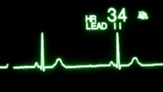 Sinus Bradycardia [upl. by Gilbertina893]