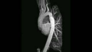 CT Angiogram  Its Better Than Stress Tests [upl. by Gnuj]