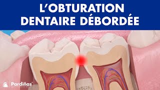 Problèmes de plombage dent – L’obturation dentaire débordée © [upl. by Hepsoj]