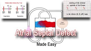 Atrial Septal Defect ASD USMLE Step 1 Pathophysiology [upl. by Rhoda]