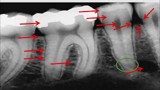 Radiographie rétro  alvéolaire [upl. by Elroy400]