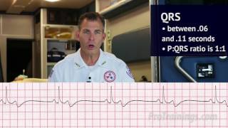 Bradycardia ECG Rhythm Interpretation [upl. by Amal]