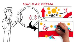 Retinal Vein Occlusion [upl. by Delwyn857]