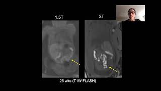 Fetal Heart Beat Audio 11 Weeks Pregnant [upl. by Baird910]