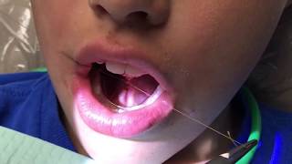 Functional frenuloplasty updated technique with lingual palatal suction [upl. by Jakob]