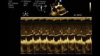 Atrial Septal Aneurysm [upl. by Udall]