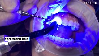 Carriere MOTION 3D CLEAR Class II Bonding  Dr Paquette amp Henry Schein Orthodontics [upl. by Eveleen]