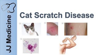 Cat Scratch Disease  Causes Symptoms and Treatment [upl. by Alel]