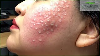 Acne Scar Treatment TCA Cross using TCA 80 [upl. by Notyad]