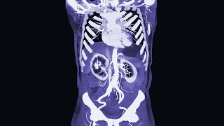 A Man Ate 2 Pounds Licorice Candy This Is What Happened To His Organs [upl. by Dovev]