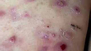 Cystic Acne Cysts Acne Dermatology Comedones and Whiteheads [upl. by Nairadas]