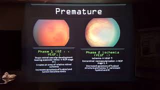 Retinopathy of prematurity by Dr Mariam El Feky [upl. by Woodley]