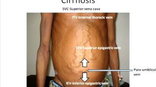 Interpreting abdominal wall veins [upl. by Ramirol]