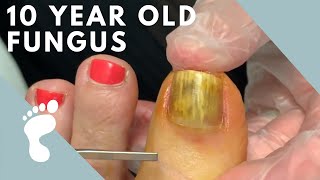 Fungus Takes Over Toenail  Toenail Removal [upl. by Anayaran]