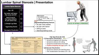 SURGERY FOR SPINAL STENOSIS [upl. by Llejk574]