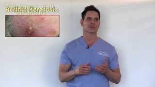 PreCancers or Actinic Keratosis Treatment Options With Dr Timothy Jochen [upl. by Eitsud]