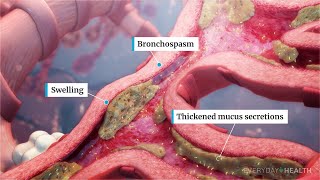 Managing COPD Exacerbation In Primary Care [upl. by Tihw]