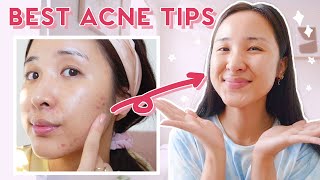 How to Use AHA BHA amp Niacinamide for ACNE amp HYPERPIGMENTATION 2021 [upl. by Pinto925]