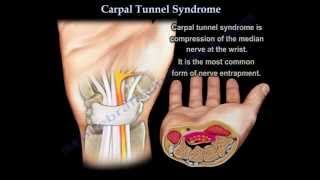 Carpal Tunnel Syndrome  Everything You Need To Know  Dr Nabil Ebraheim [upl. by Pasol]