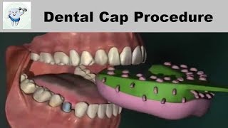 Dental Cap Fixing Procedure [upl. by Demetrius]