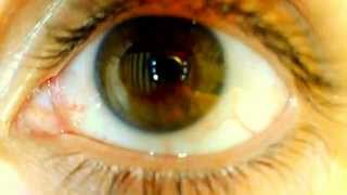 Physiologic optokinetic nystagmus [upl. by Ahsemad]