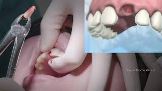 LIVE SURGERY DENTAL EXTRACTION AND BONE GRAFT [upl. by At]