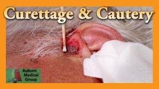 Curettage and Cautery for Basal Cell Carcinoma  Auburn Medical Group [upl. by Valina890]