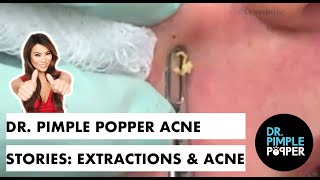 Dr Pimple Popper Acne Stories Extractions amp Acne [upl. by Barnie834]