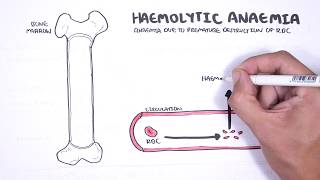 Haemolytic Anaemia  classification intravascular extravascular pathophysiology investigations [upl. by Solracnauj]