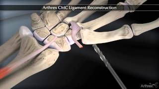 Arthrex CMC Ligament Reconstruction [upl. by Hanimay]