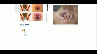 Hemorrhoids Lecture for USMLE [upl. by Enilatan525]