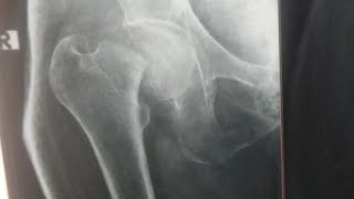 Hip Fracture in Elderly [upl. by Cramer]