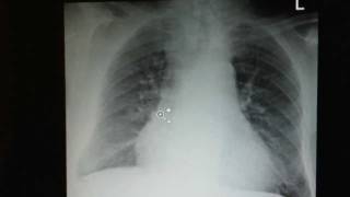 COPD How to Recognize it on a Chest XRay [upl. by Adnarb]