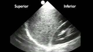 Anleitung Ultraschallerkennung von Pleuraflüssigkeit [upl. by Idoj640]