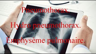 Pneumothorax  Hydro pneumothorax  Emphysème pulmonaire [upl. by Collen]