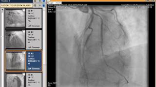 The Basics of Coronary CT Angiography [upl. by Ennahgem]